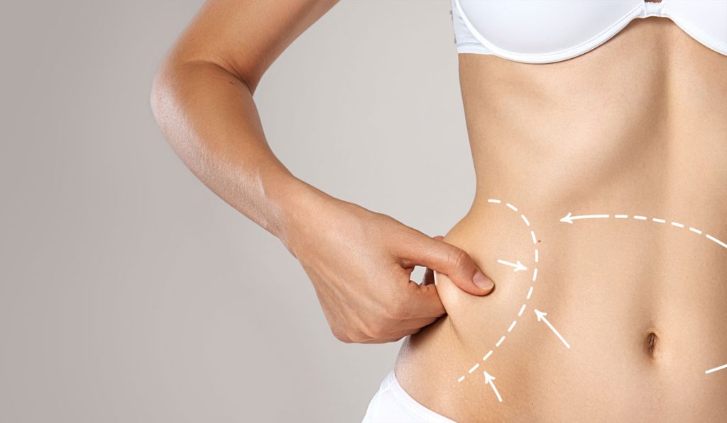 Top Liposuction Tips: Your Ultimate Guide For Successful Results